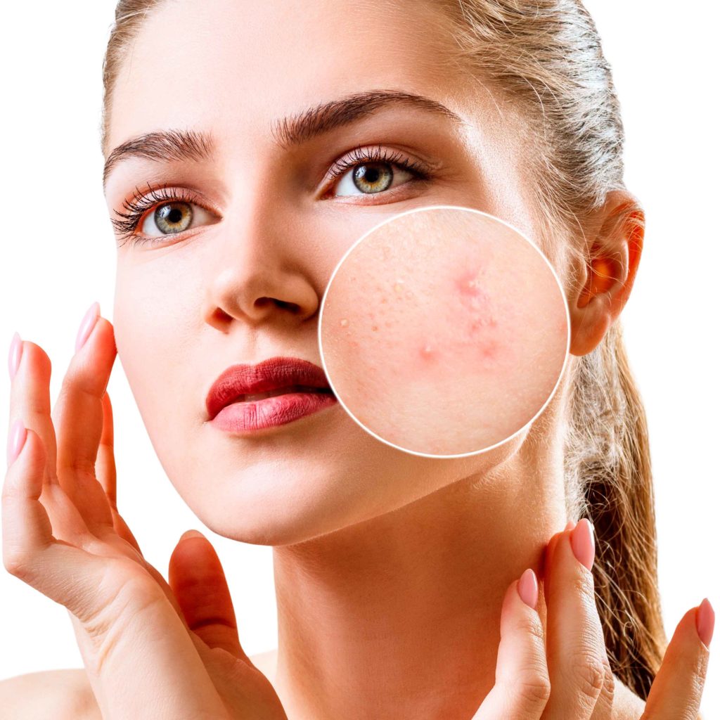 acne-dermatitis